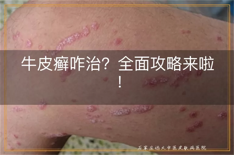 牛皮癣咋治？全面攻略来啦！