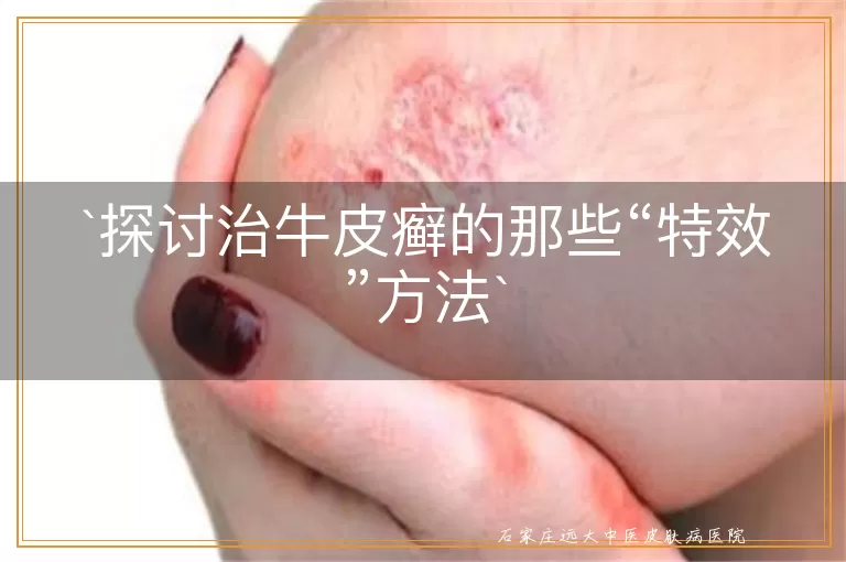 探讨治牛皮癣的那些“特效”方法
