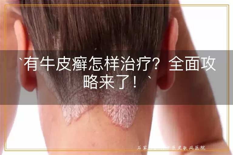 有牛皮癣怎样治疗？全面攻略来了！