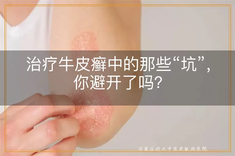 治疗牛皮癣中的那些“坑”，你避开了吗？