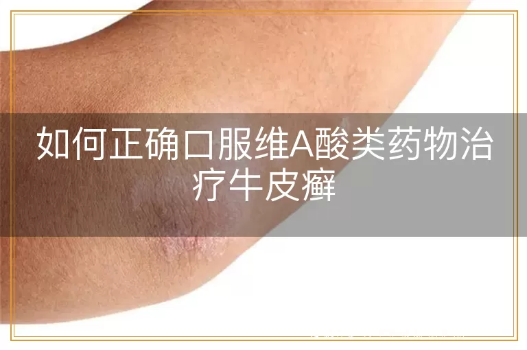 如何正确口服维A酸类药物治疗牛皮癣