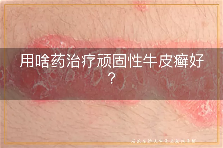 用啥药治疗顽固性牛皮癣好？