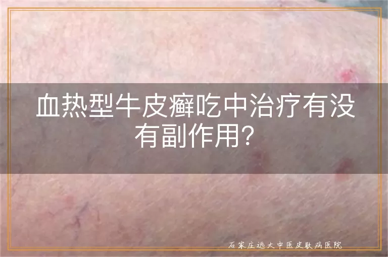 血热型牛皮癣吃中治疗有没有副作用？
