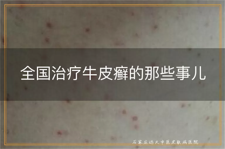 全国治疗牛皮癣的那些事儿