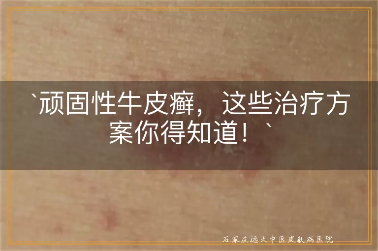顽固性牛皮癣，这些治疗方案你得知道！