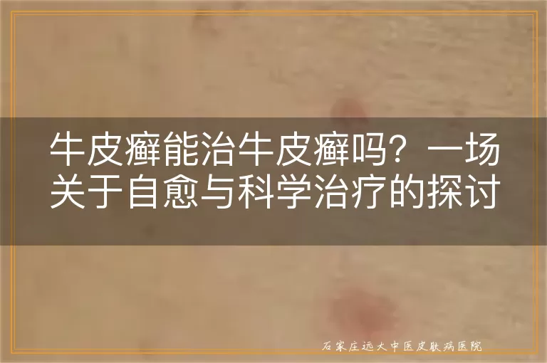 牛皮癣能治牛皮癣吗？一场关于自愈与科学治疗的探讨