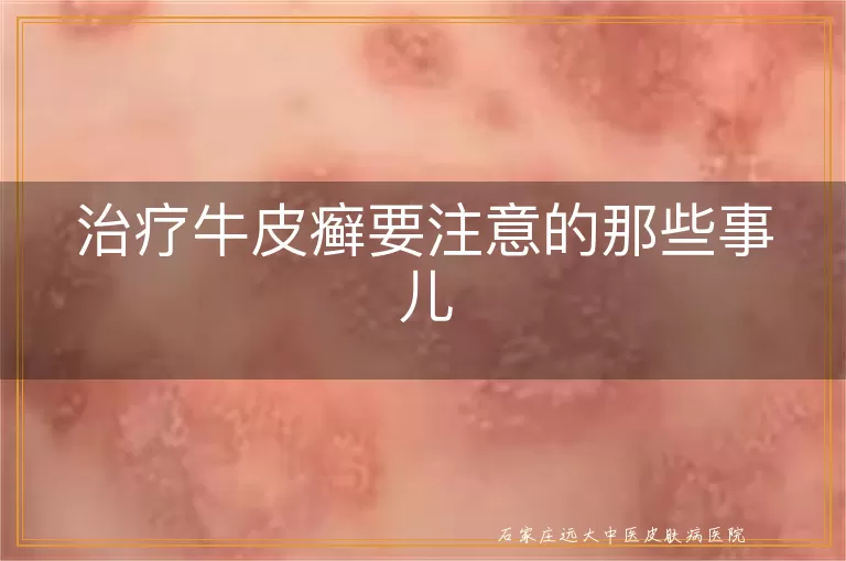 治疗牛皮癣要注意的那些事儿