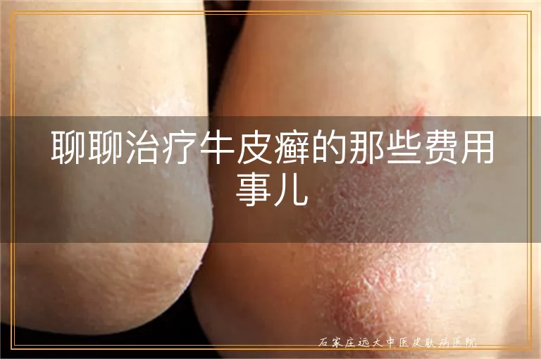 聊聊治疗牛皮癣的那些费用事儿