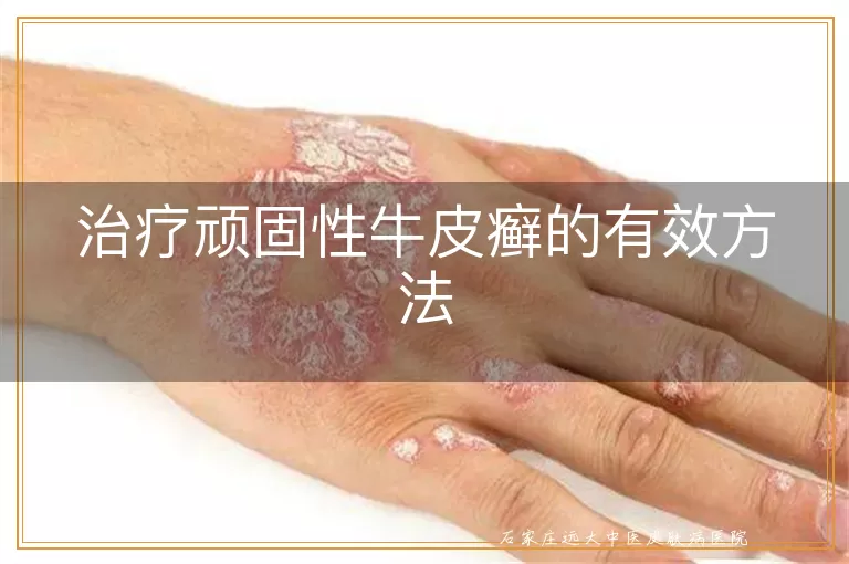 治疗顽固性牛皮癣的有效方法