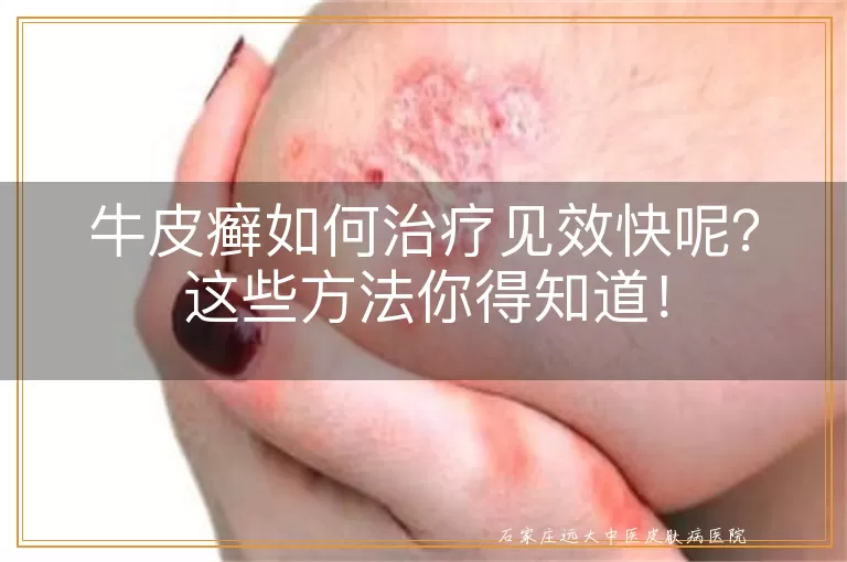 牛皮癣如何治疗见效快呢？这些方法你得知道！
