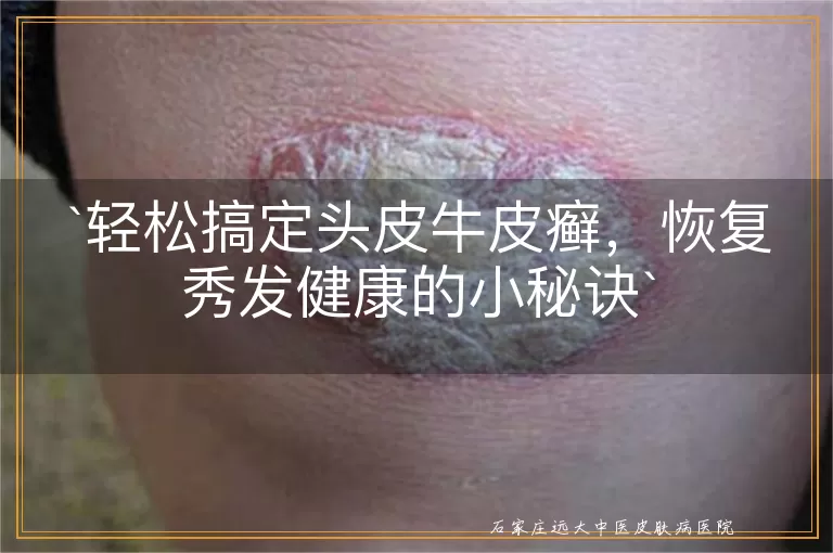 轻松搞定头皮牛皮癣，恢复秀发健康的小秘诀