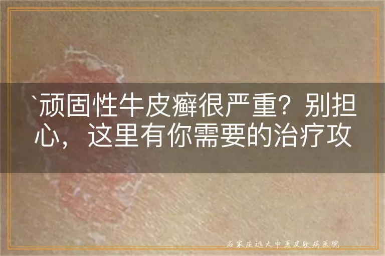 顽固性牛皮癣很严重？别担心，这里有你需要的治疗攻略！