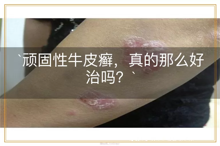 顽固性牛皮癣，真的那么好治吗？