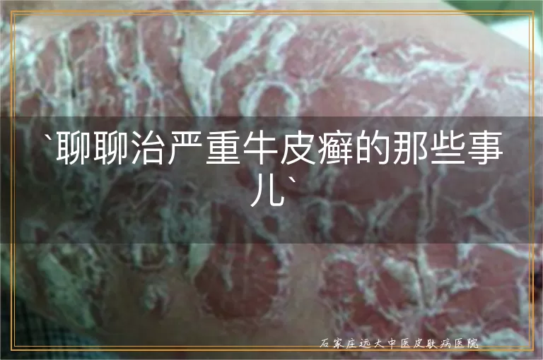 聊聊治严重牛皮癣的那些事儿