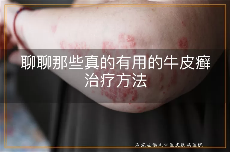 聊聊那些真的有用的牛皮癣治疗方法