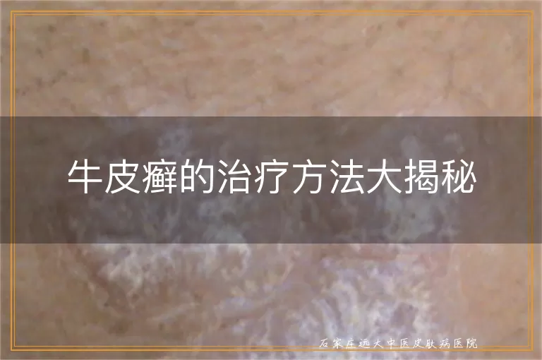 牛皮癣的治疗方法大揭秘