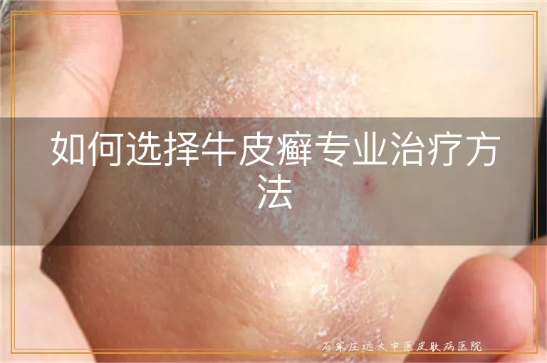 如何选择牛皮癣专业治疗方法