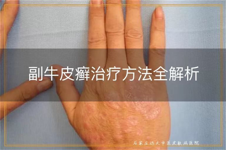 副牛皮癣治疗方法全解析