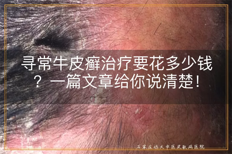 寻常牛皮癣治疗要花多少钱?一篇文章给你说清楚!