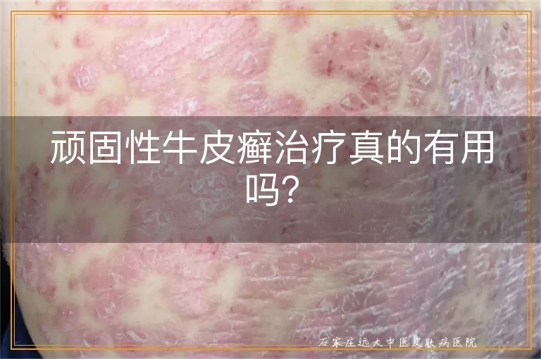 顽固性牛皮癣治疗真的有用吗?