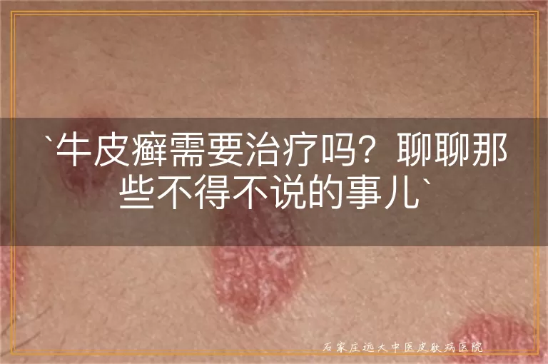 牛皮癣需要治疗吗？聊聊那些不得不说的事儿