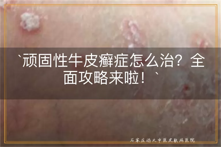 顽固性牛皮癣症怎么治？全面攻略来啦！