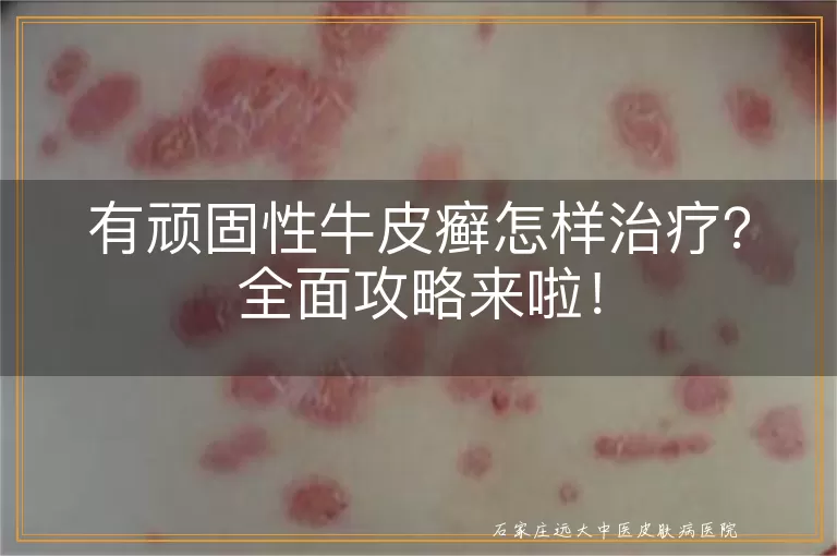 有顽固性牛皮癣怎样治疗？全面攻略来啦！