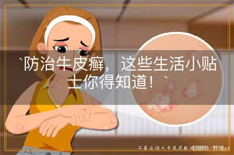 防治牛皮癣,这些生活小贴士你得知道!