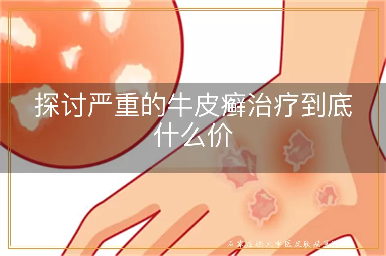 探讨严重的牛皮癣治疗到底什么价