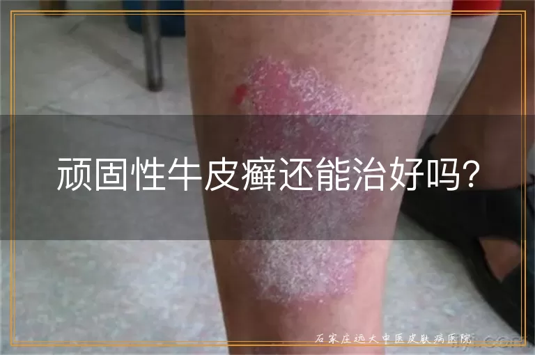 顽固性牛皮癣还能治好吗?