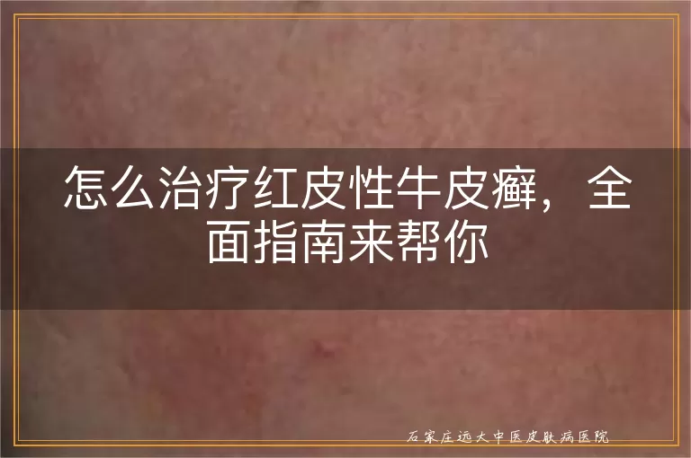 怎么治疗红皮性牛皮癣,全面指南来帮你