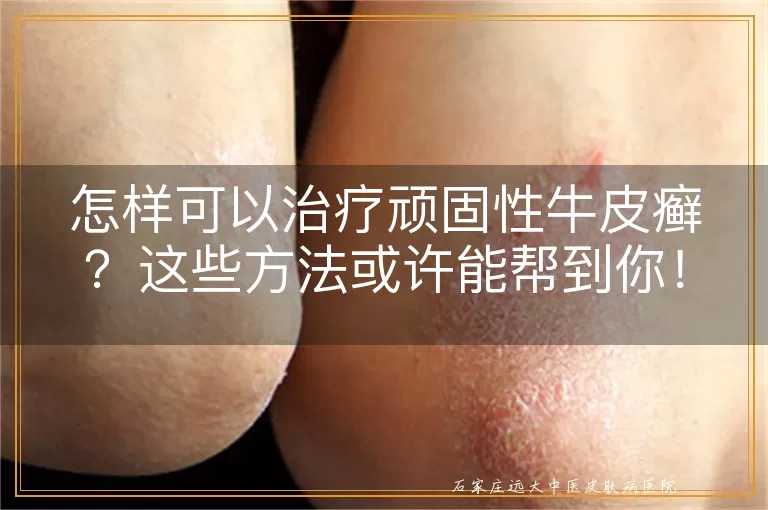 怎样可以治疗顽固性牛皮癣?这些方法或许能帮到你!
