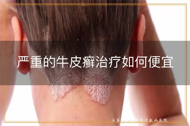 严重的牛皮癣治疗如何便宜