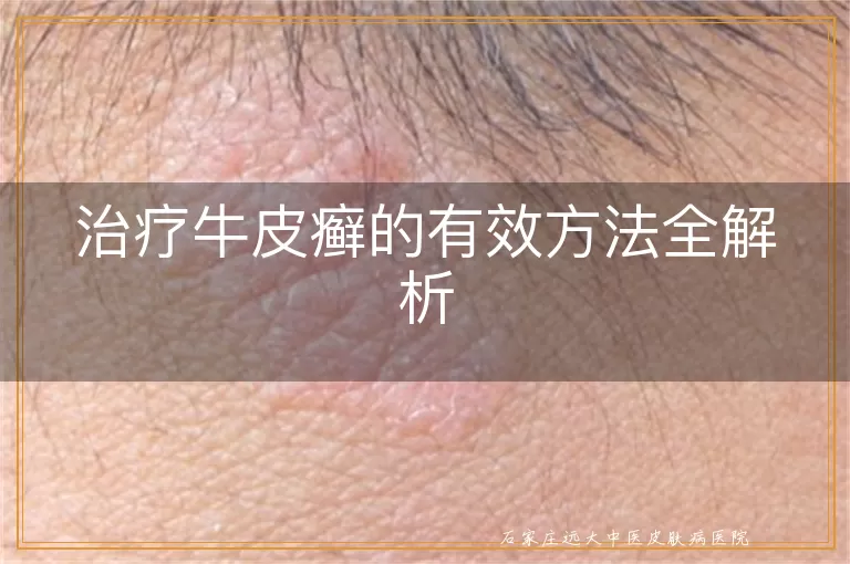 治疗牛皮癣的有效方法全解析