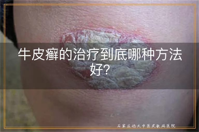 牛皮癣的治疗到底哪种方法好?