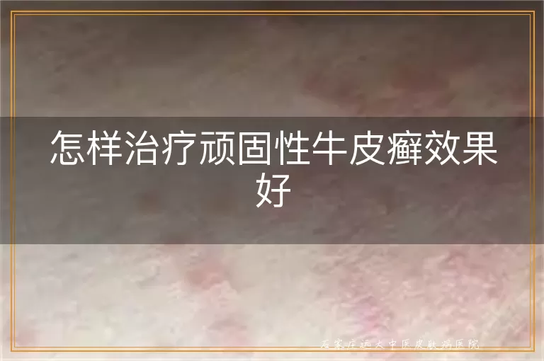 怎样治疗顽固性牛皮癣效果好