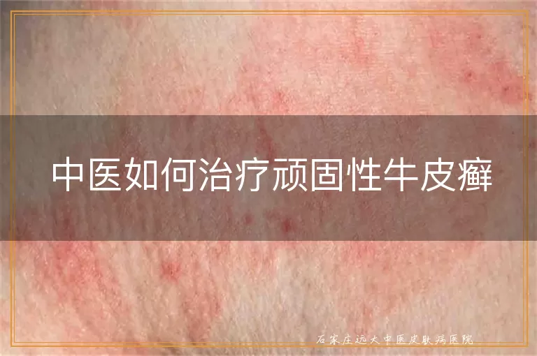 中医如何治疗顽固性牛皮癣