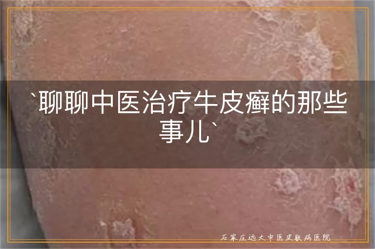 聊聊中医治疗牛皮癣的那些事儿