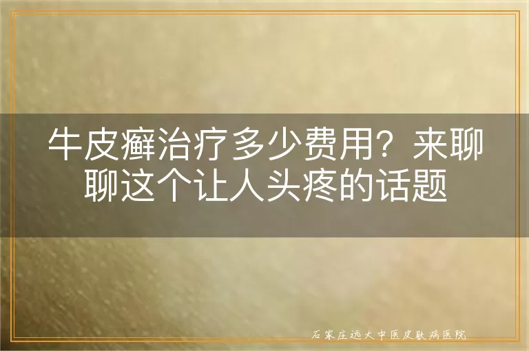 牛皮癣治疗多少费用?来聊聊这个让人头疼的话题