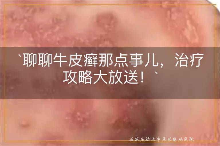 聊聊牛皮癣那点事儿,治疗攻略大放送!