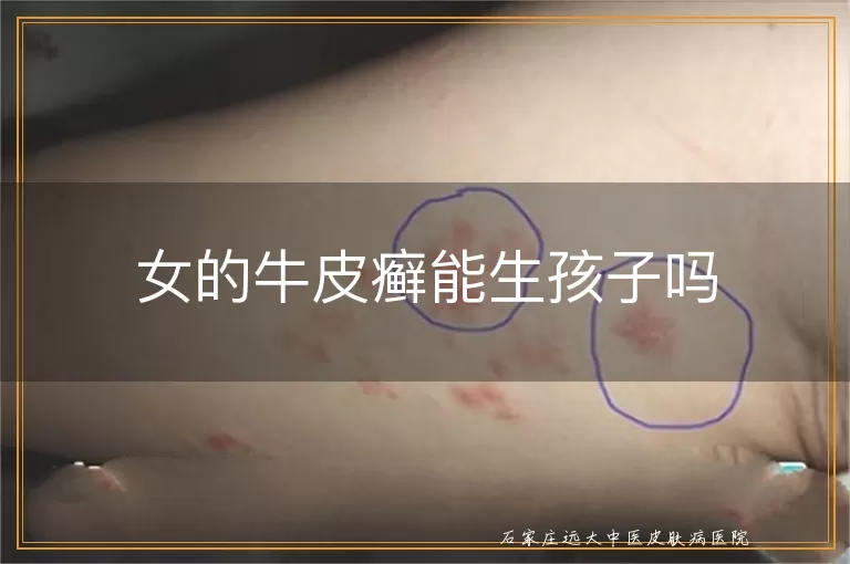 女的牛皮癣能生孩子吗