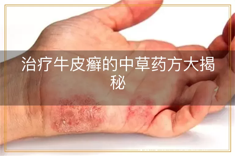治疗牛皮癣的中草药方大揭秘