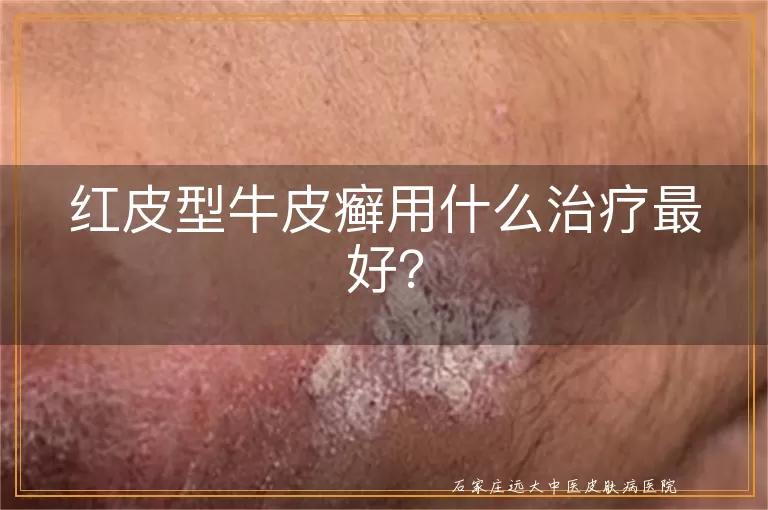 红皮型牛皮癣用什么治疗最好？