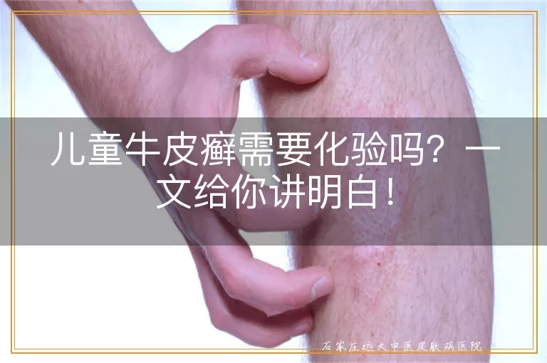 儿童牛皮癣需要化验吗？一文给你讲明白！
