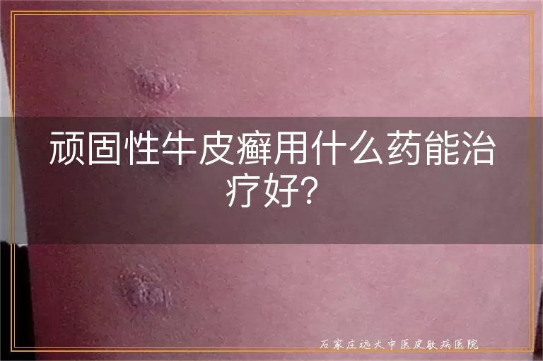 顽固性牛皮癣用什么药能治疗好？