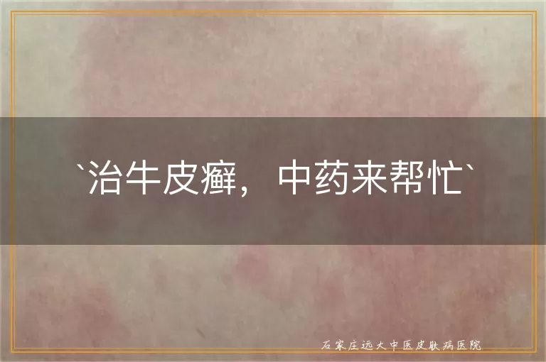 治牛皮癣，中药来帮忙