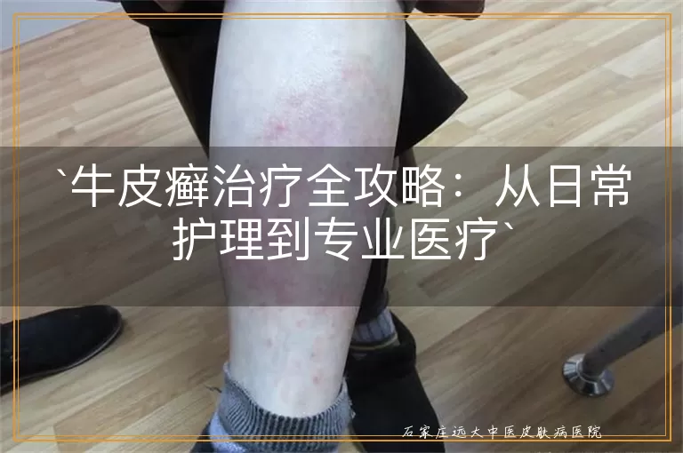 牛皮癣治疗全攻略：从日常护理到专业医疗