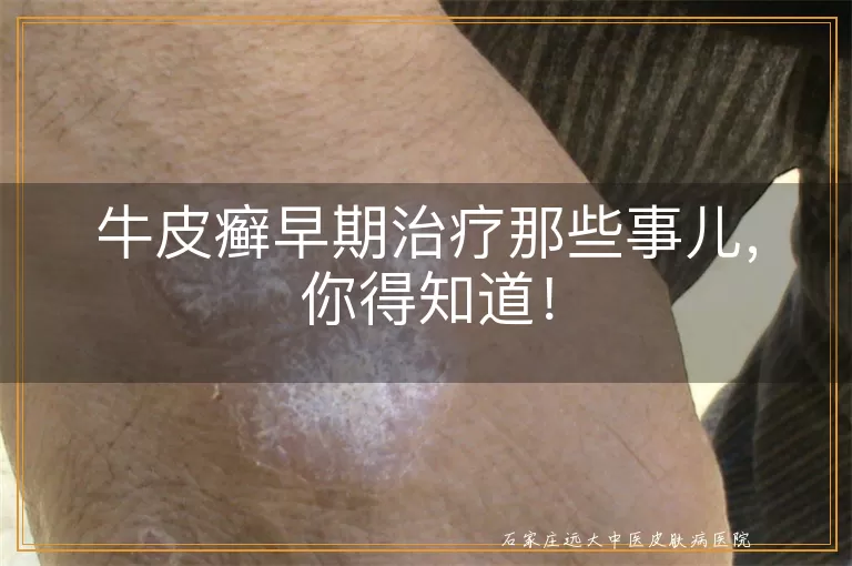 牛皮癣早期治疗那些事儿，你得知道！