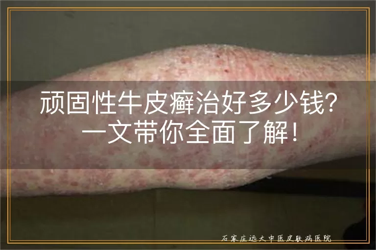 顽固性牛皮癣治好多少钱？一文带你全面了解！