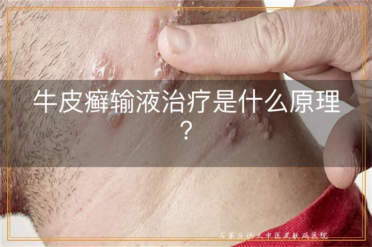 牛皮癣输液治疗是什么原理？